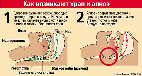 Средство от храпа в аптеках нижнего новгорода