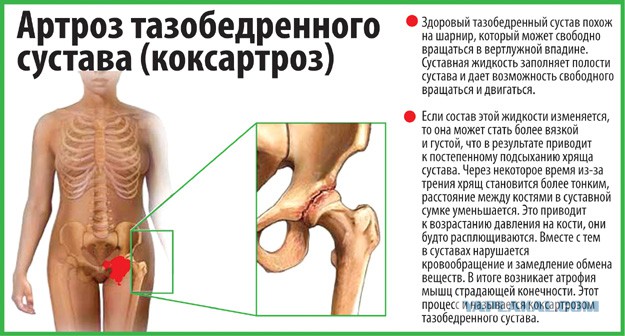 Артрит от артроза тазобедренный сустав Артрит от артроза тазобедренный сустав