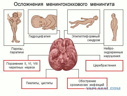 Менингит как лечить его в домашних условиях
