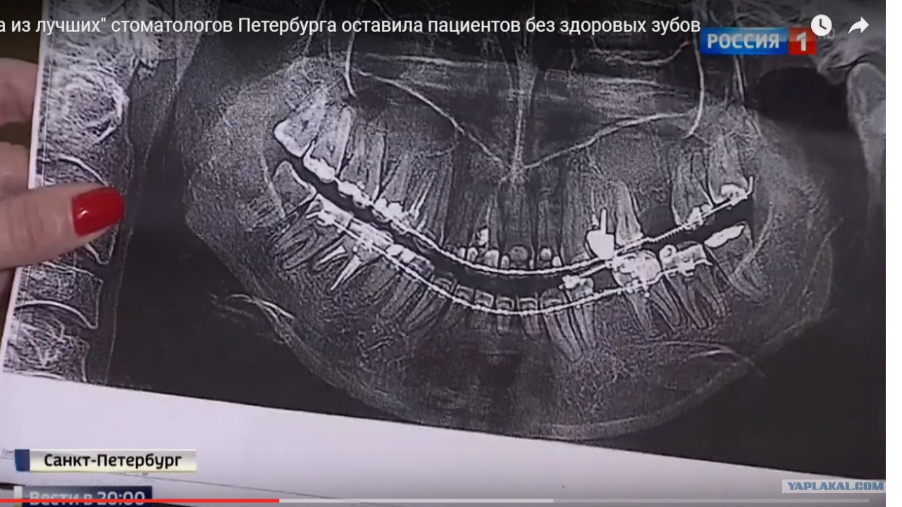 Удаление пациентки зубов Удаление пациентки зубов