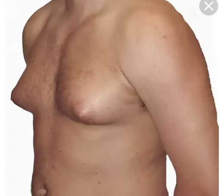 Upturned Breasts