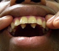 Удаление лишнего зуба