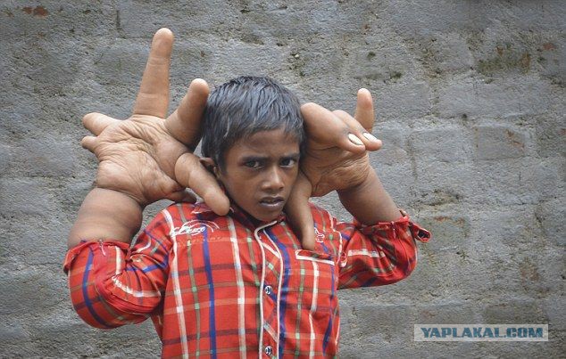 Индийский мальчик с гигантскими руками