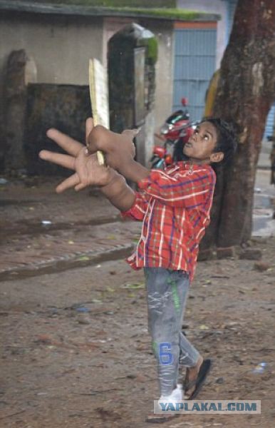 Индийский мальчик с гигантскими руками