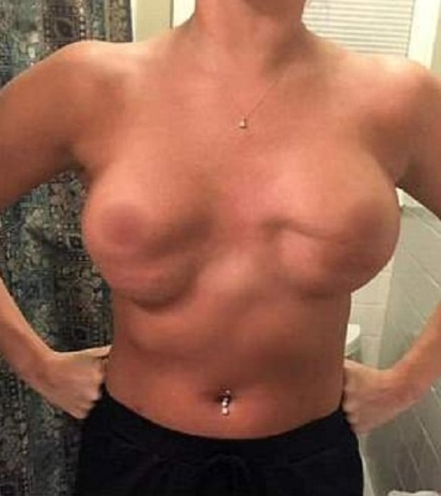 В результате неудачной пластической операции у девушки раздвоилась грудь