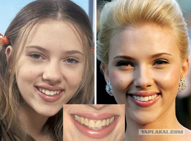 10 знаменитостей до и после реставрации зубов