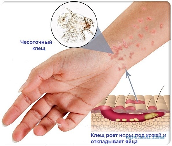 Чесотка общемировая зараза