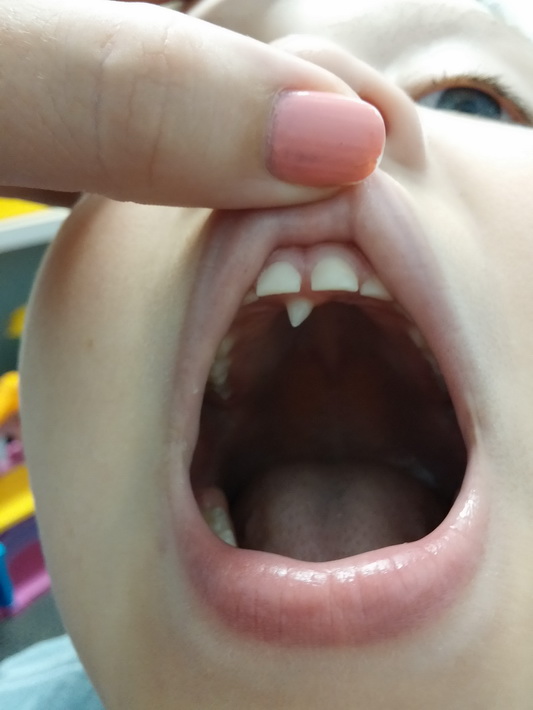Удаление лишнего зуба