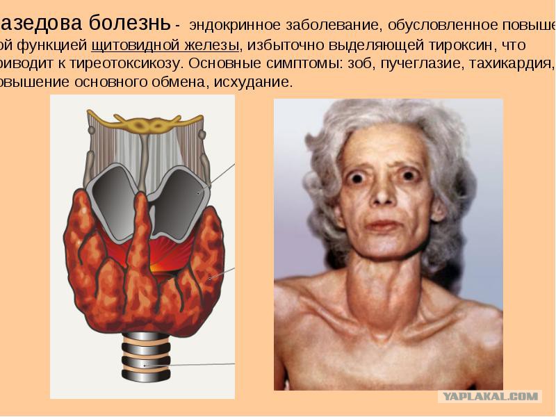 Базедова болезнь связана с
