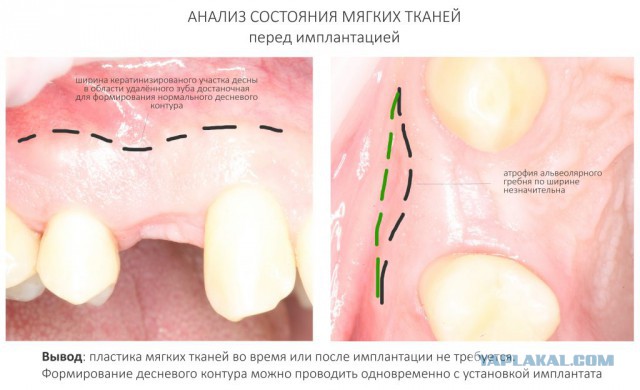 Установка имплантата: как это делается?