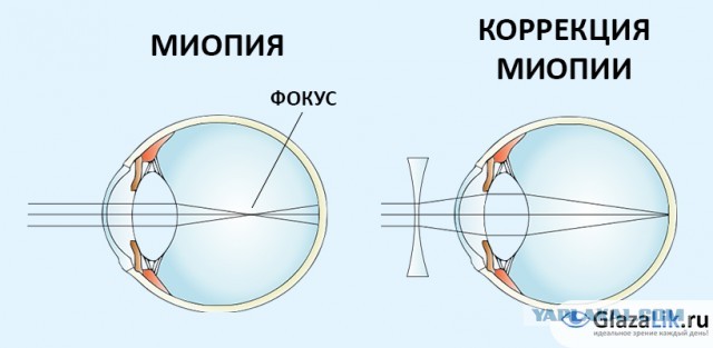 Что ищут офтальмологи у пациентов с астигматизмом?