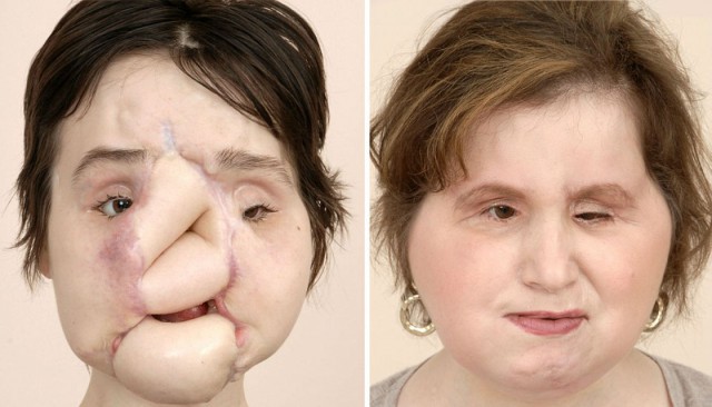 В свои 21 она является самой молодой женщиной, которой сделали пересадку лица.