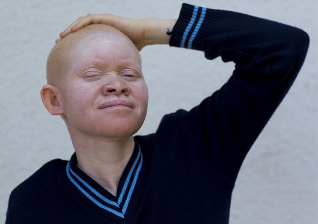 Танзанийские альбиносы, чьи тела стоят дороже