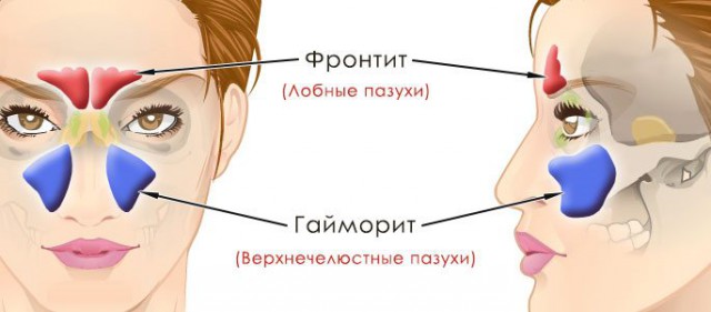 Лечил гайморит (фронтит), просверлили лоб