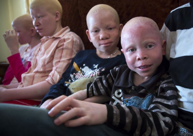 Танзанийские альбиносы, чьи тела стоят дороже