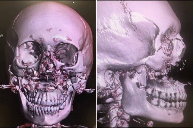 Красноярские врачи по косточке собрали раздробленное лицо девушки после ДТП