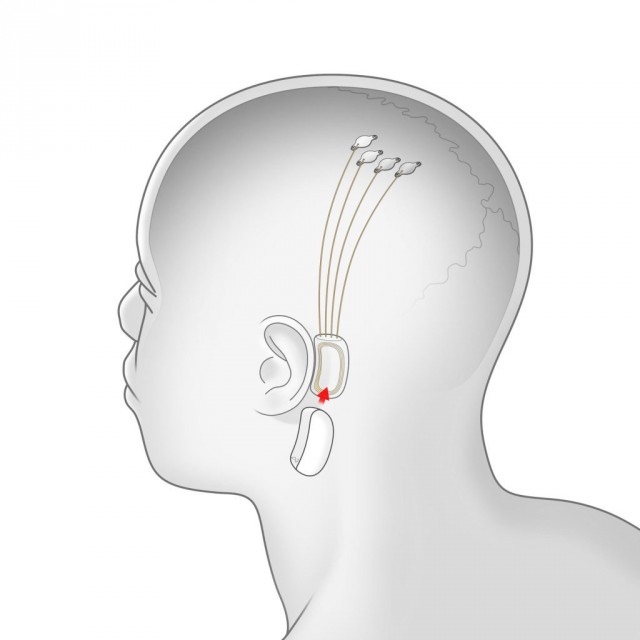 Стартап Илона Маска Neuralink представил считывающие информацию из мозга «нити»-импланты и вживляющего их робота