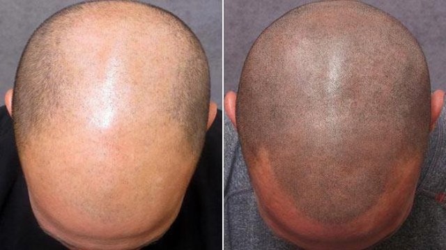 Картинки по запросу ճաղատություն