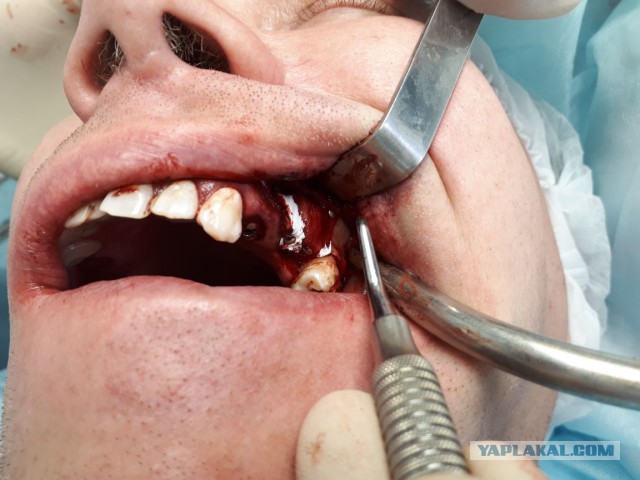 Установка металлокерамической коронки на зуб. Как ставят коронку на зуб