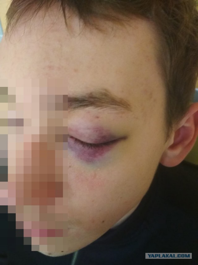 Подросток попал в больницу после ударов рыжего мужчины в метро