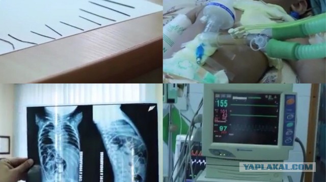 Узбекские врачи обнаружили в теле 11-месячного ребенка 16 стальных иголок