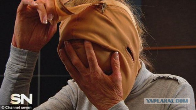 Жизнь без лица закончена: австралийка сняла маску