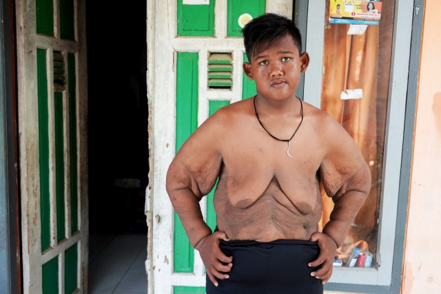 Самый толстый мальчик в мире сбросил половину своего веса