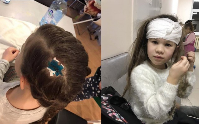 Упавший с высотки кирпич пробил голову 6-летней девочке в Долгопрудном