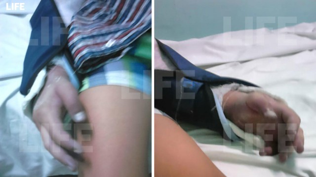 В Ростовской области врачебная безалаберность привела к ампутации руки ребёнку