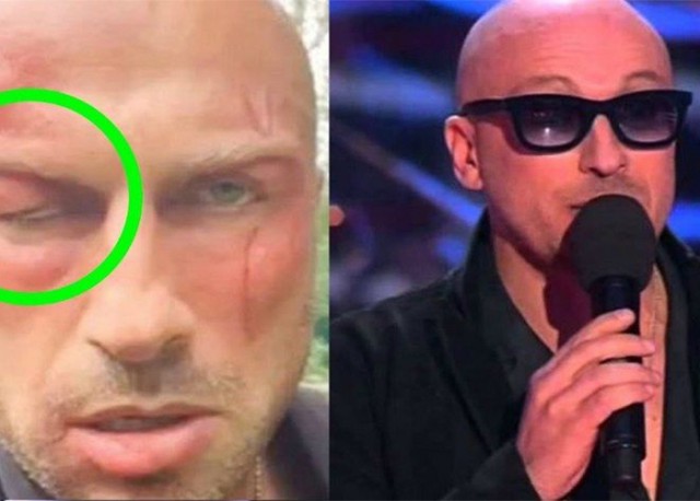 Почему Нагиев все время в очках: странные дефекты знаменитых актеров