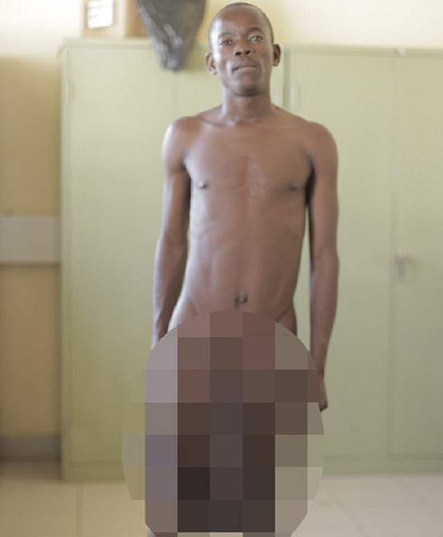 Африканский школьник попал под нож хирурга из-за слишком большого полового органа