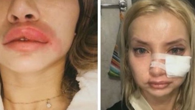 «Раздувало лицо, голову». Девушка попала в реанимацию после уколов у косметолога-самоучки