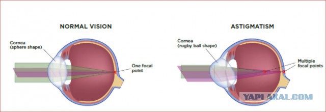 Что ищут офтальмологи у пациентов с астигматизмом?
