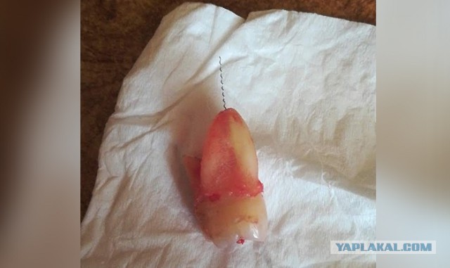 Стоматолог оставила инструмент в зубе пациентки