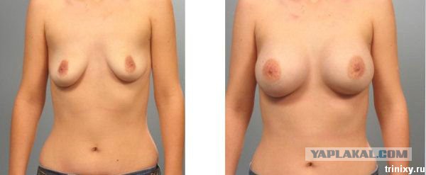 Некоторым девушкам силиконовая грудь просто