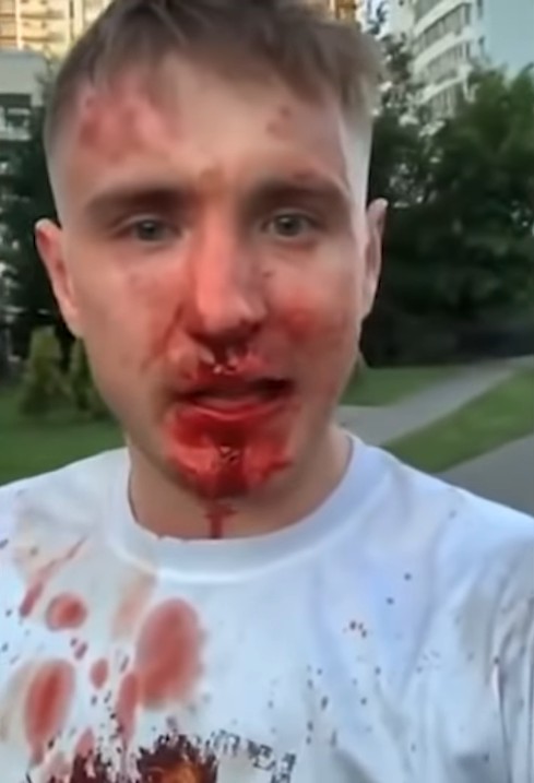 Один против пятерых. Избитый, но не сломленный.