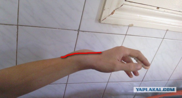 Упала сосулька на руку