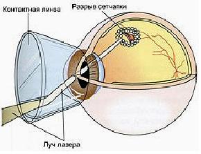 Что ищут офтальмологи у пациентов с отслойкой сетчатки?