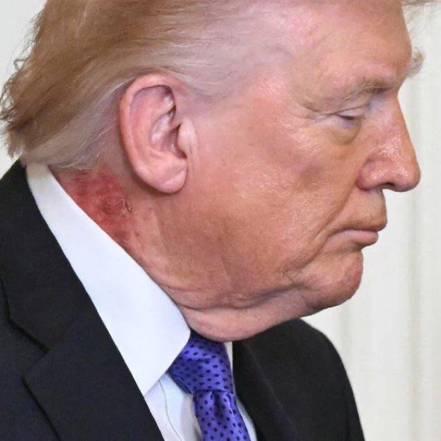Трамп появился на мероприятии в Белом доме с крупным раздражением на шее