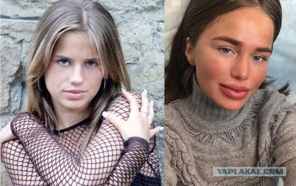10 худших пластических операций знаменитостей