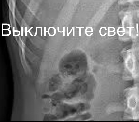 Рентген-снимки с обручальным кольцом стали новым свадебным трендом в соцсетях