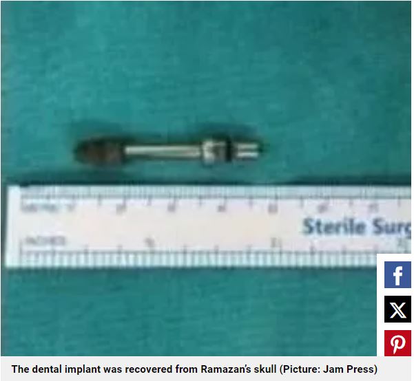Турецкий стоматолог завинтил зубной имплант в мозг