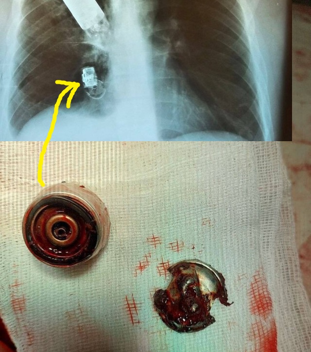 В День Медицинского работника донецкие врачи извлекли из грудной клетки военнослужащего неразорвавшуюся гранату