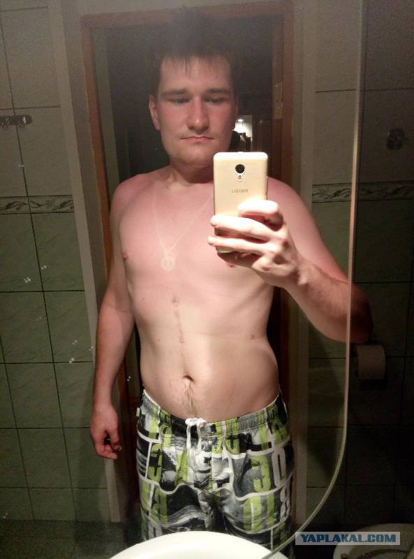 Гастрошунтирование или как я стал стройным