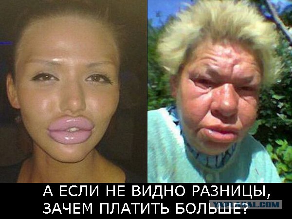 Девушки, знайте меру! До и после пластики