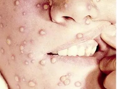 Ученые впервые в истории заразили человека искусственным вирусом для уничтожения раковых клеток в организме