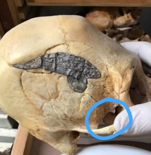 Череп древнего воина с металлической пластиной (Фото)