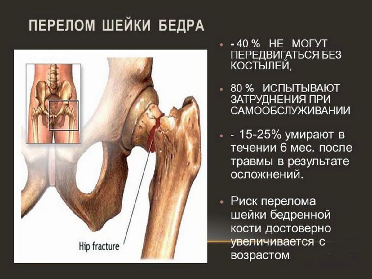 Трещина шейки. Признаки перелома шейки бедра у пожилых людей 80. Характерный симптом при переломе шейки бедренной кости. Перелом кости шейки бедра в пожилом возрасте. Перелом шейки бедренной кости клиника.