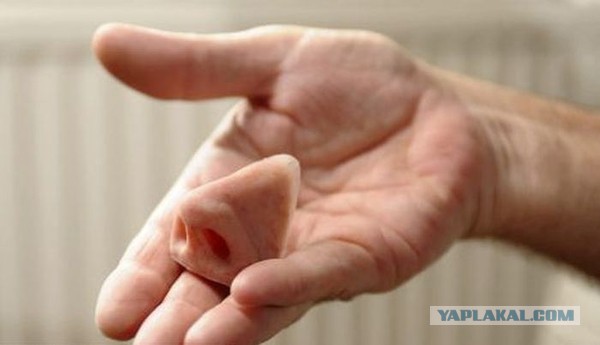В Алабаме родился малыш без носа