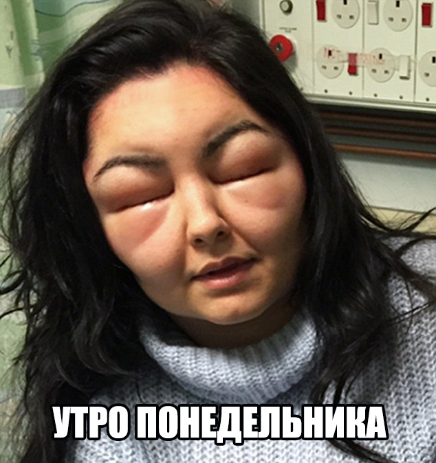 Девушка превратилась в урода из-за аллергиии